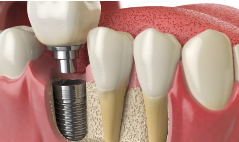 Dental Implants West Jordan UT