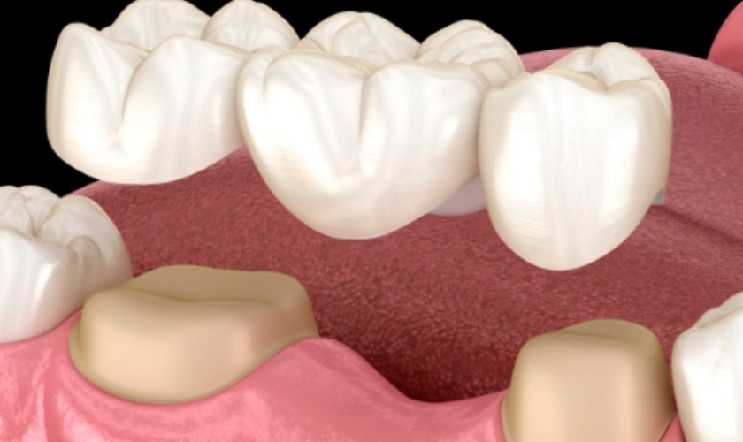 Dental Bridges West Jordan